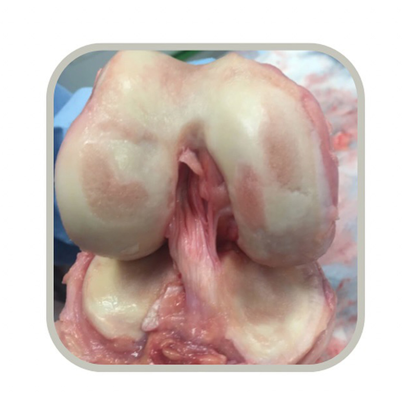 髌骨软化症一直说膝关节软骨损伤不要拖，不然等很疼了、磨穿了，损伤也就变严重了来