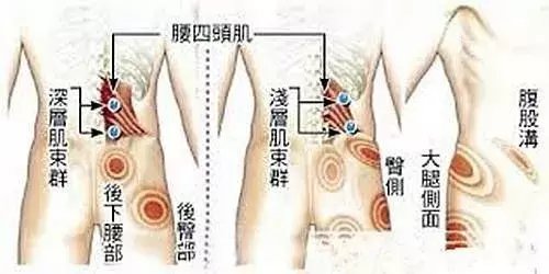 分清腰肌筋膜炎与腰肌劳损, 掌握自我疗法