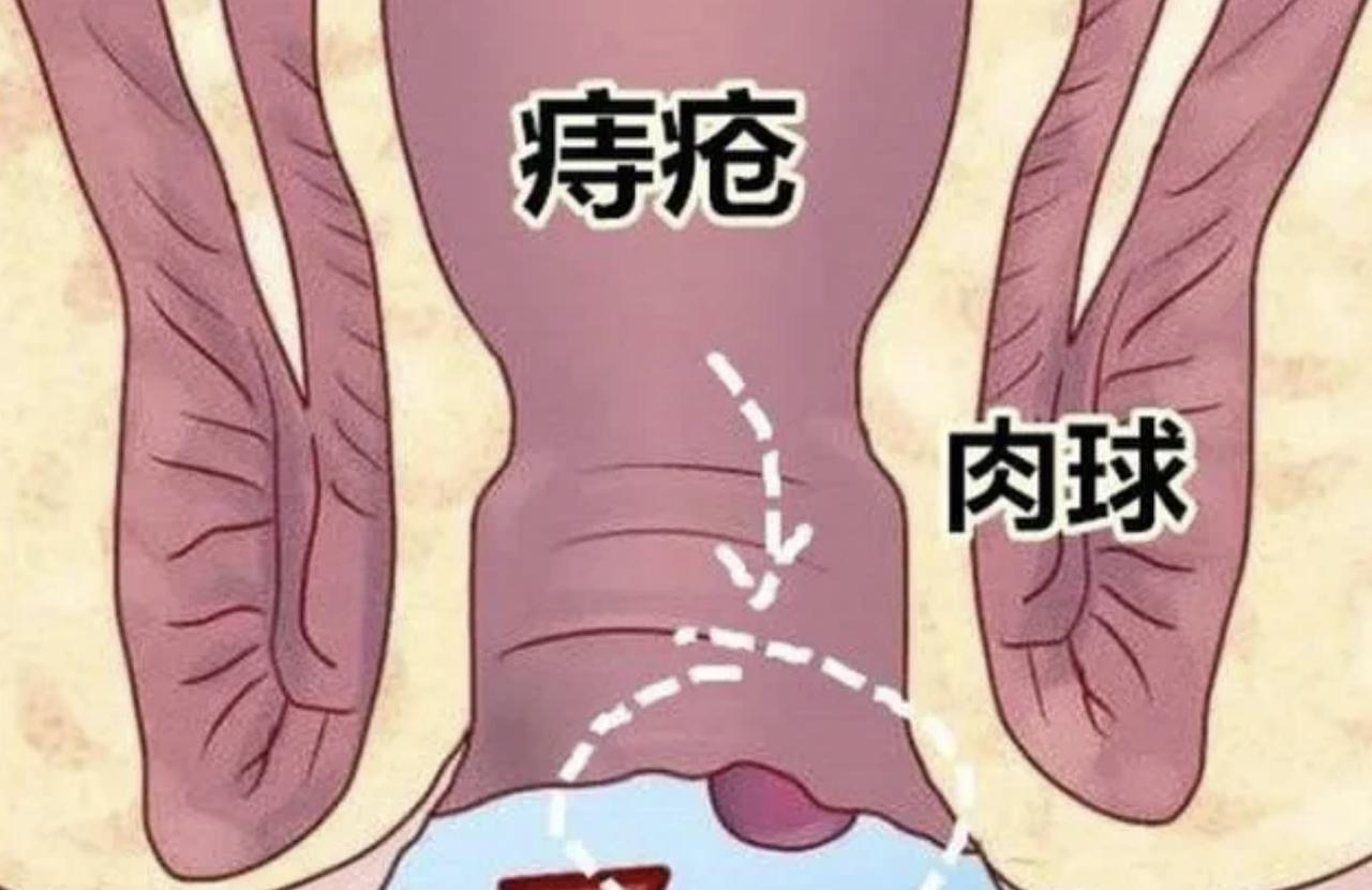 网传女子自行割痔疮致大出血，痔疮可以在家自行处理吗？注：以下为网络流传案例，