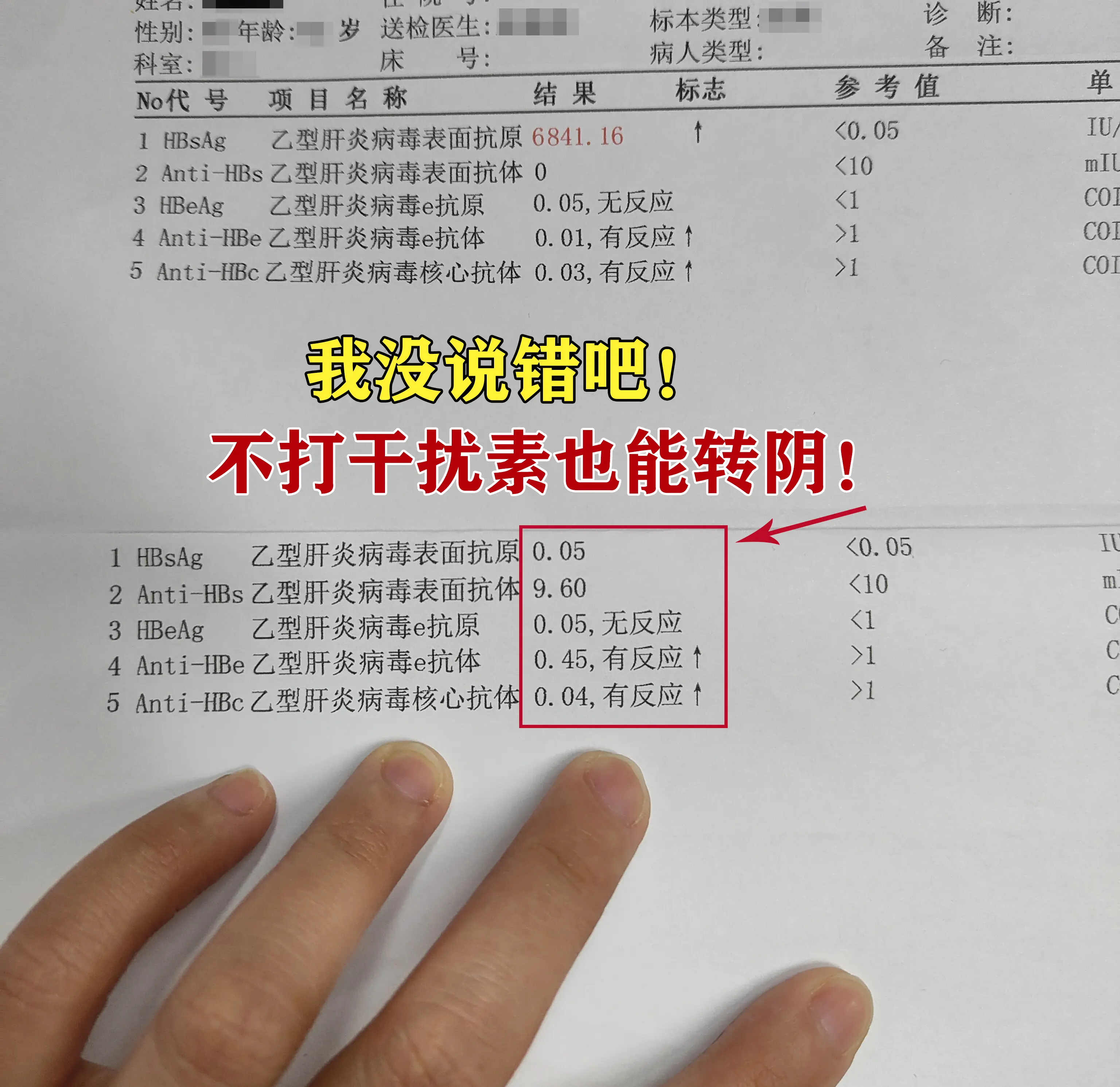 这位患者初诊时为小三阳，表面抗原6000多，不少人建议他想转阴只能用干...