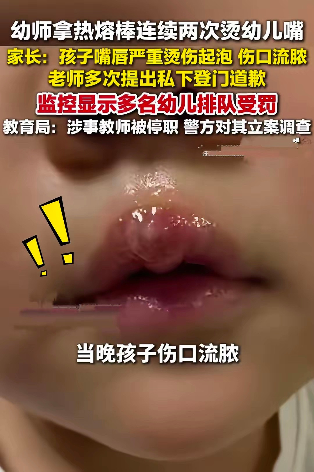 热熔胶烫伤嘴唇也烫坏家长信任这是要多变态的心理才能做出这样的事？这种心思歹毒的人
