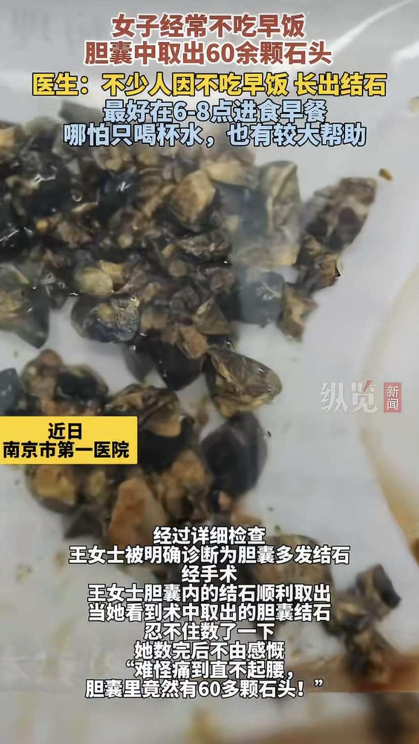 太吓人!3月3日，南京35岁女子聚餐后肚子剧痛，去医院一查，医生从她体内取出这玩