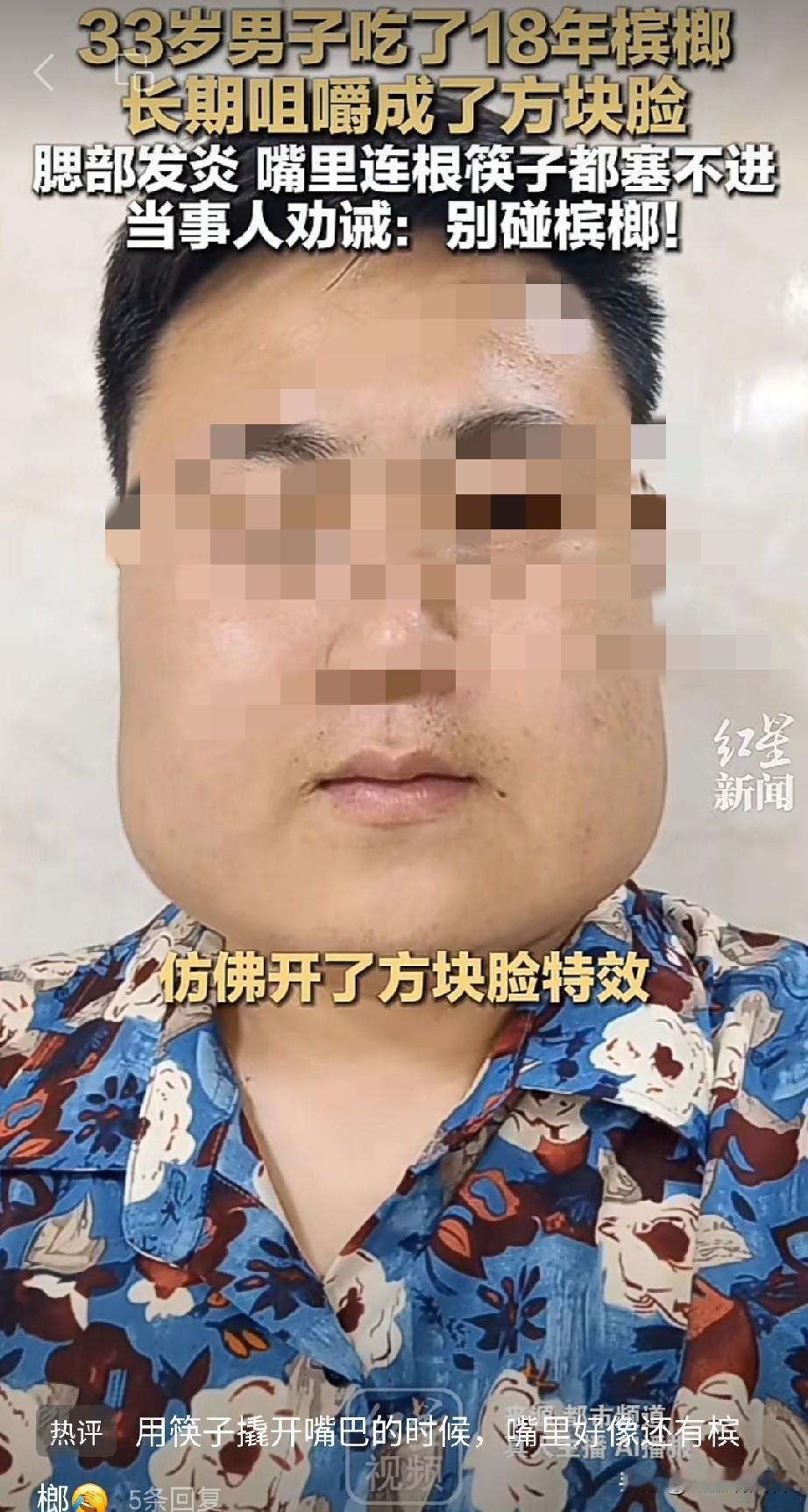 刷到这事真的挺唏嘘，33岁男子嚼了18年槟榔，活生生把脸嚼成了方块脸。要是