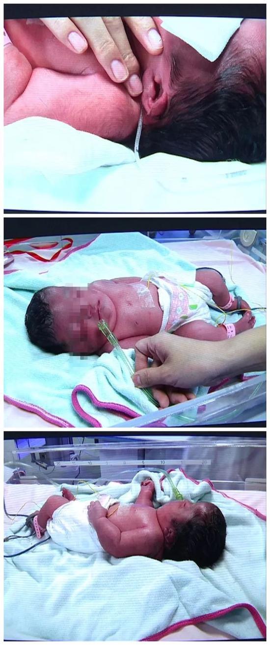 二胎妈妈保胎7个月打了几百针 孩子出生却是畸形