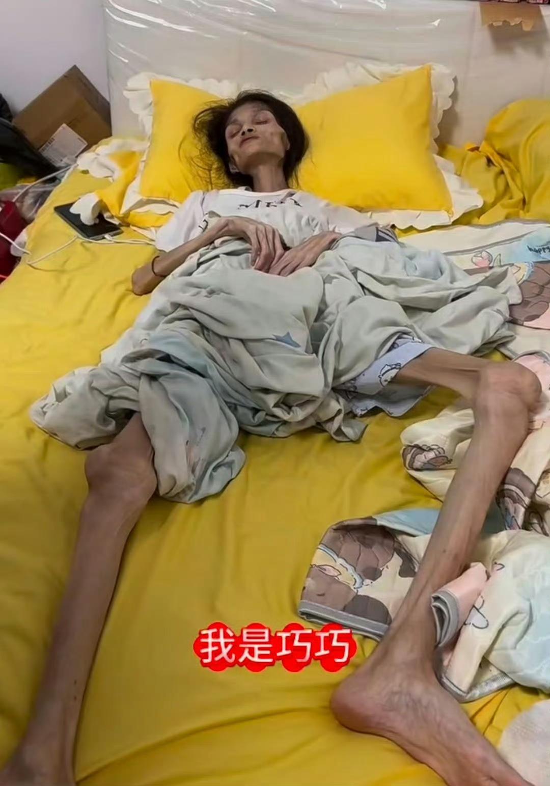 💔27岁女孩脑萎缩去世：从90斤暴瘦35斤，临终遗言让全网泪崩1.生命