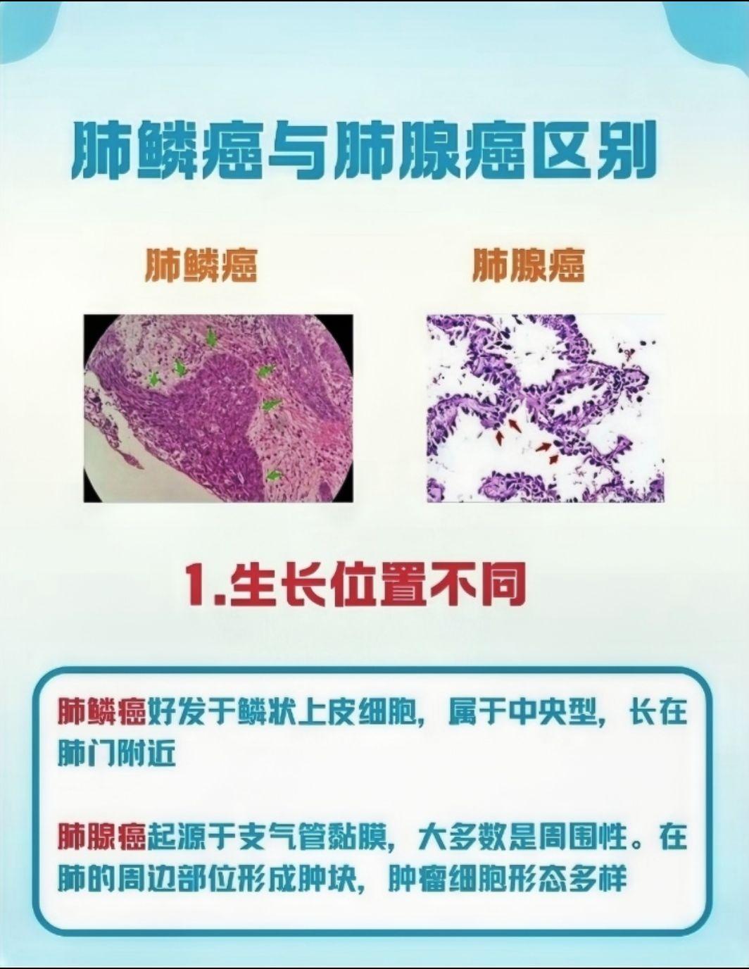 肺腺癌 带你了解肺腺癌与肺鳞癌的区别！