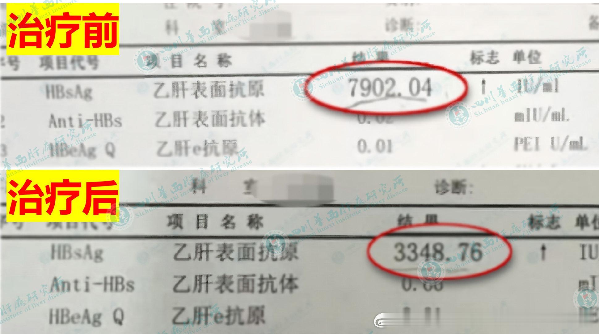患者复查传来好消息，乙肝表面抗原从7902降到3348[点赞]规范抗病毒+中药调理，管住嘴、坚持运动
