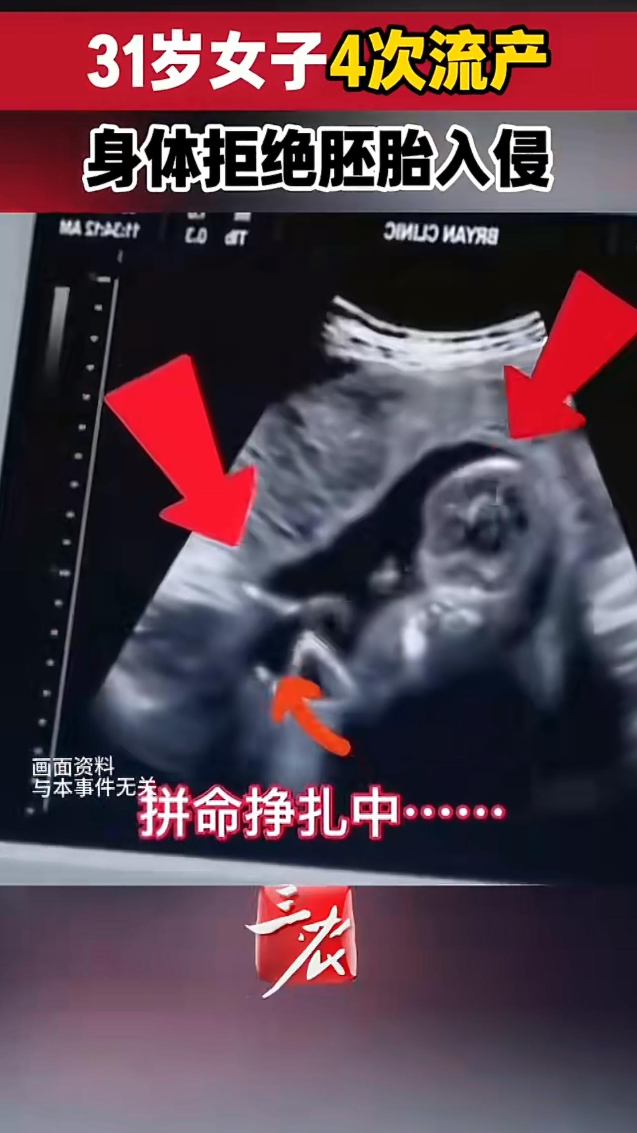 一则“女子免疫系统攻击胚胎8年反复流产”的新闻牵动了无数人的心，31岁的汪女士结