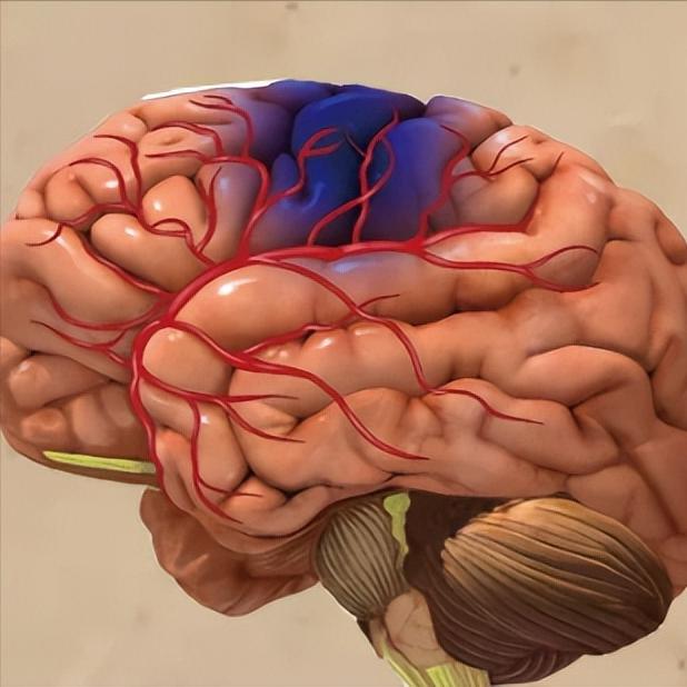 脑梗最危险的时刻是早上！4个救命动作，现在知道还不晚很多脑梗患者和家属都不知