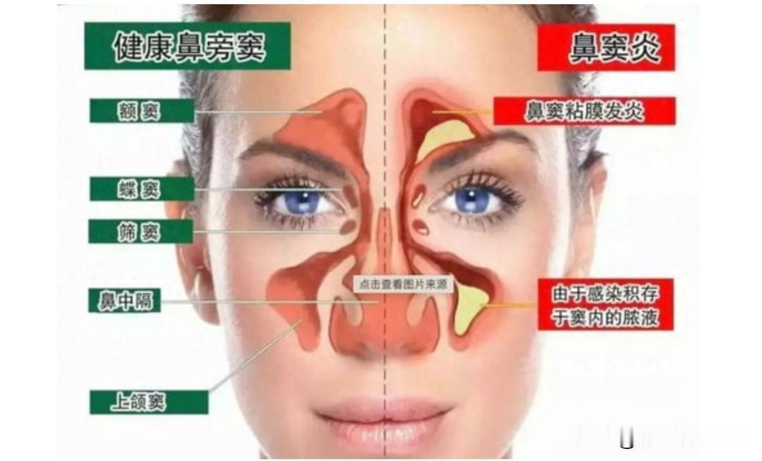 反复鼻塞流涕？5个经典中成药调理慢性鼻炎，温和通窍不刺激，一文读懂慢性鼻炎