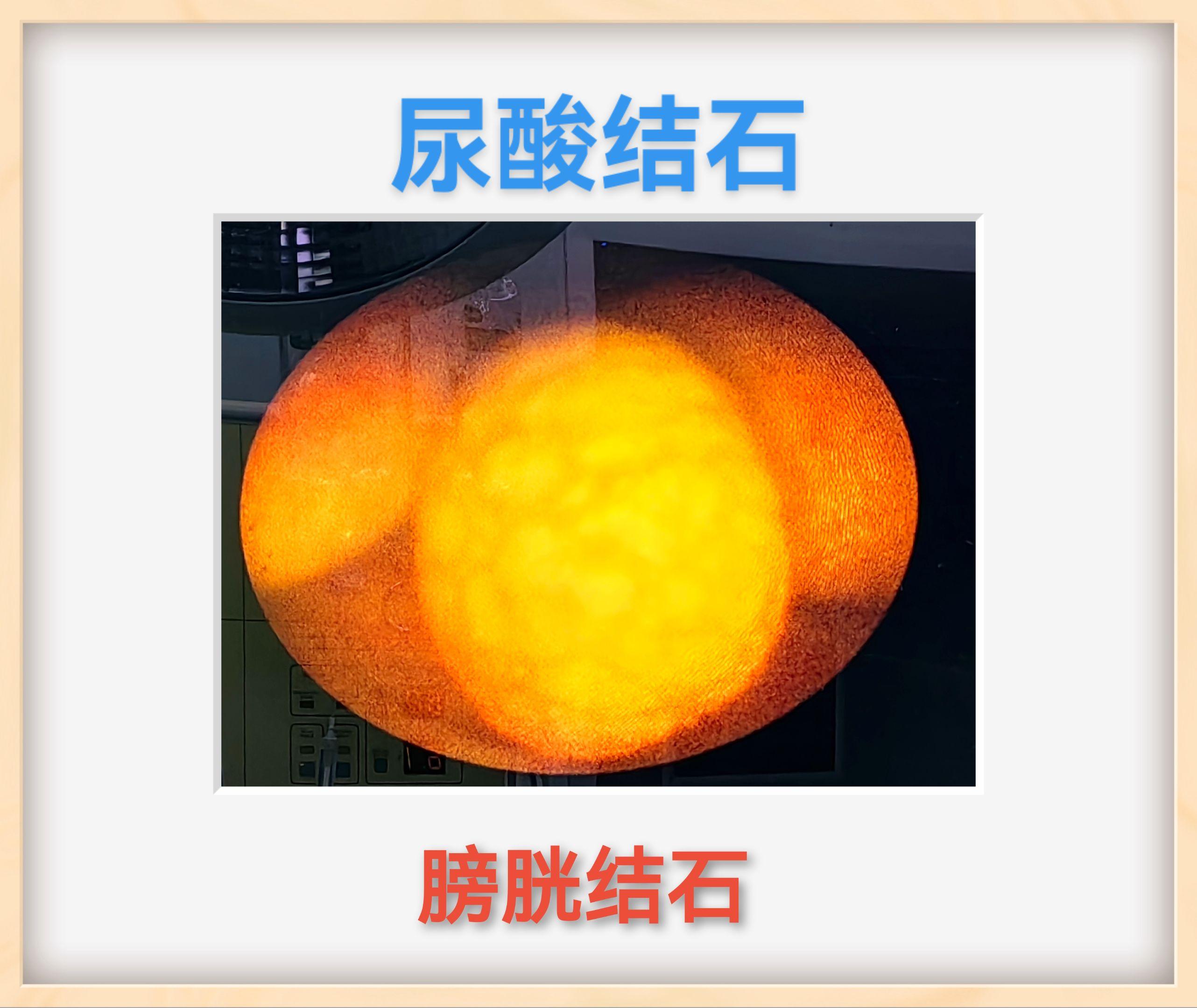 结石结石分析—尿酸结石。尿酸结石是体内尿酸代谢异常，导致尿液中尿酸过高...