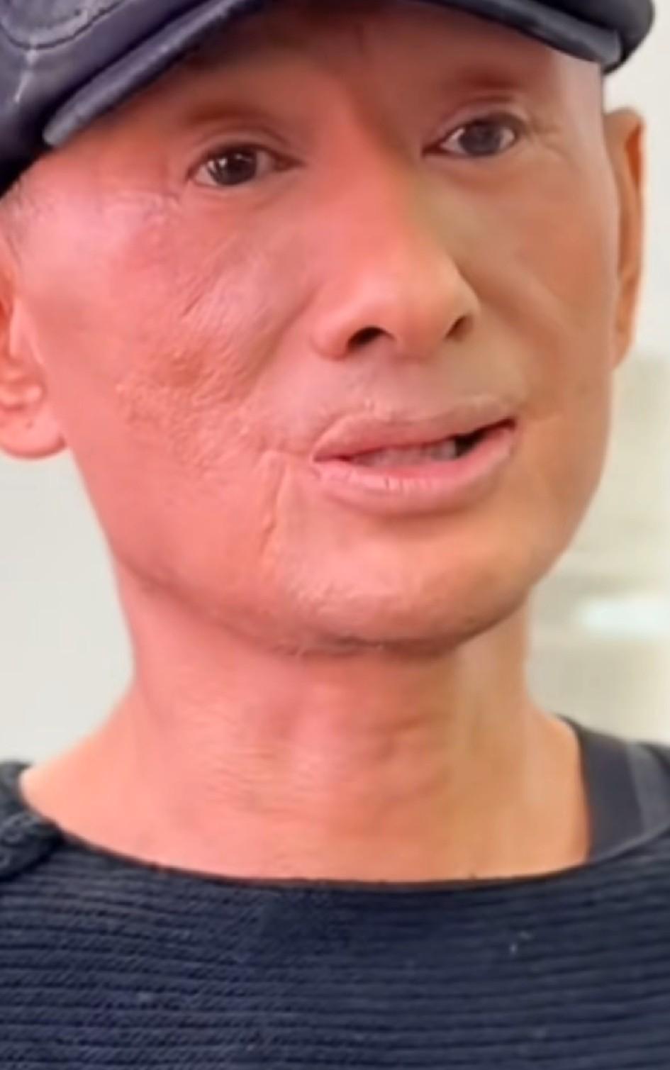 歌手阿宝现状曝光，脸部嘴角疑似烧伤，痕迹明显像做过手术，此前否认被封杀，开名车住