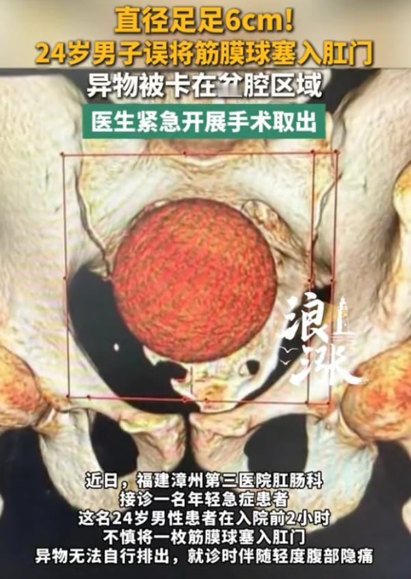 “丢人丢大了！”8月17日报道，福建漳州，一男子不小心，将一枚筋膜球塞入肛门里面