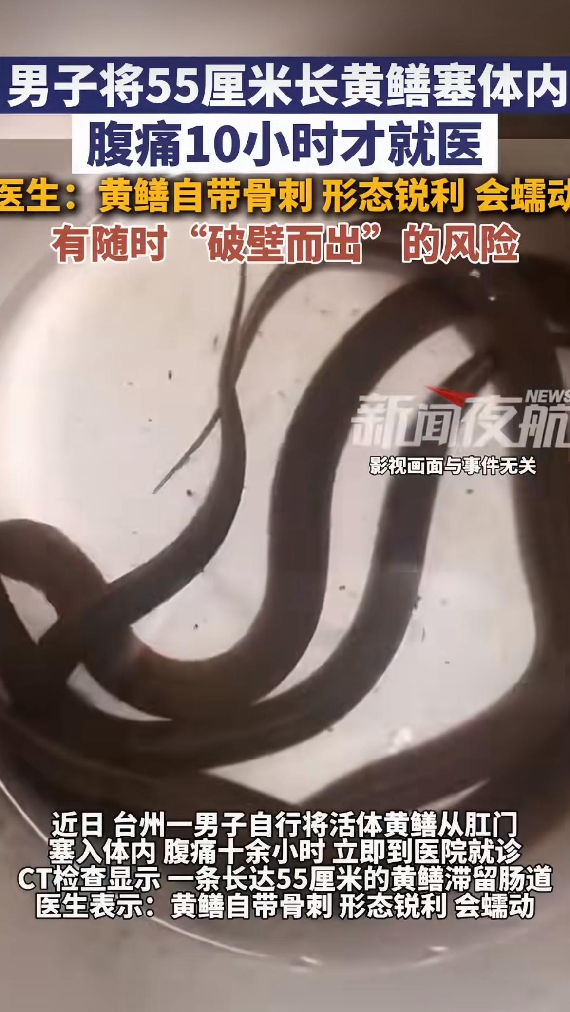 浙江台州，小伙子把一条活黄鳝从肛门塞进去，黄鳝在肠子里乱钻，他硬扛了10多个小时