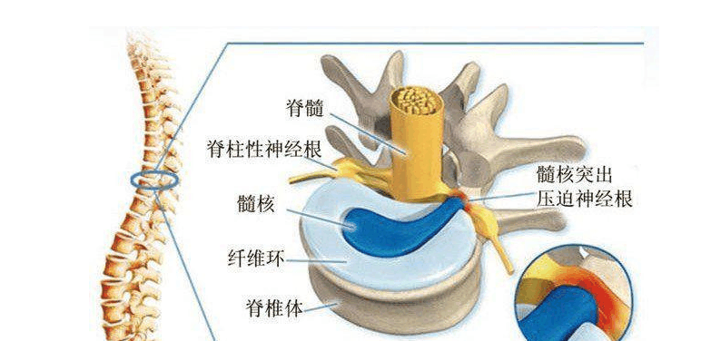 椎间盘的构成分为三个部分,软骨终板,纤维环和髓核.