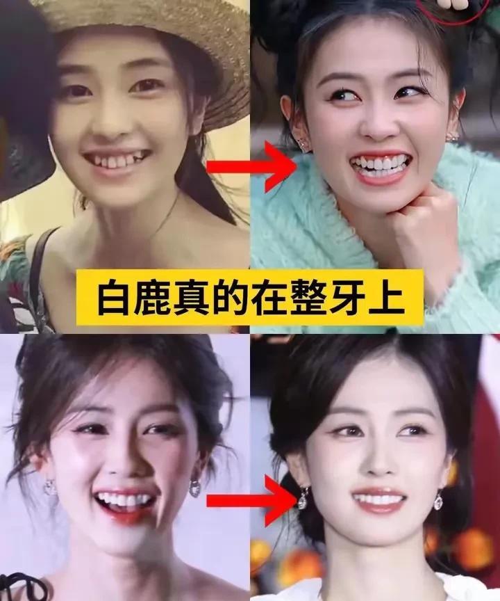 明星换牙惊天内幕：白鹿刘涛的'一口假牙'代价有多大？25年后恐成噩梦！