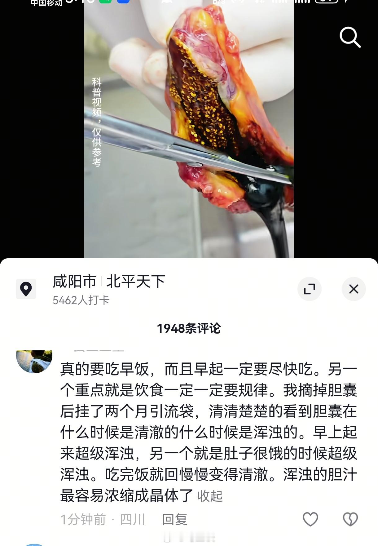 看完大家一定要记得吃早饭！每一顿早餐都是给胆囊温柔的抚慰，早晨及时进食可以让胆汁