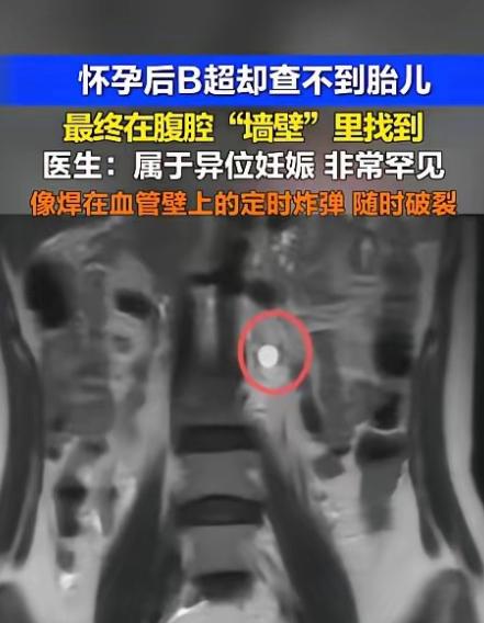惊悚！深圳一位女子验孕棒显示怀孕，然而B超检查却不见胎儿踪影。待CT扫描结果出来