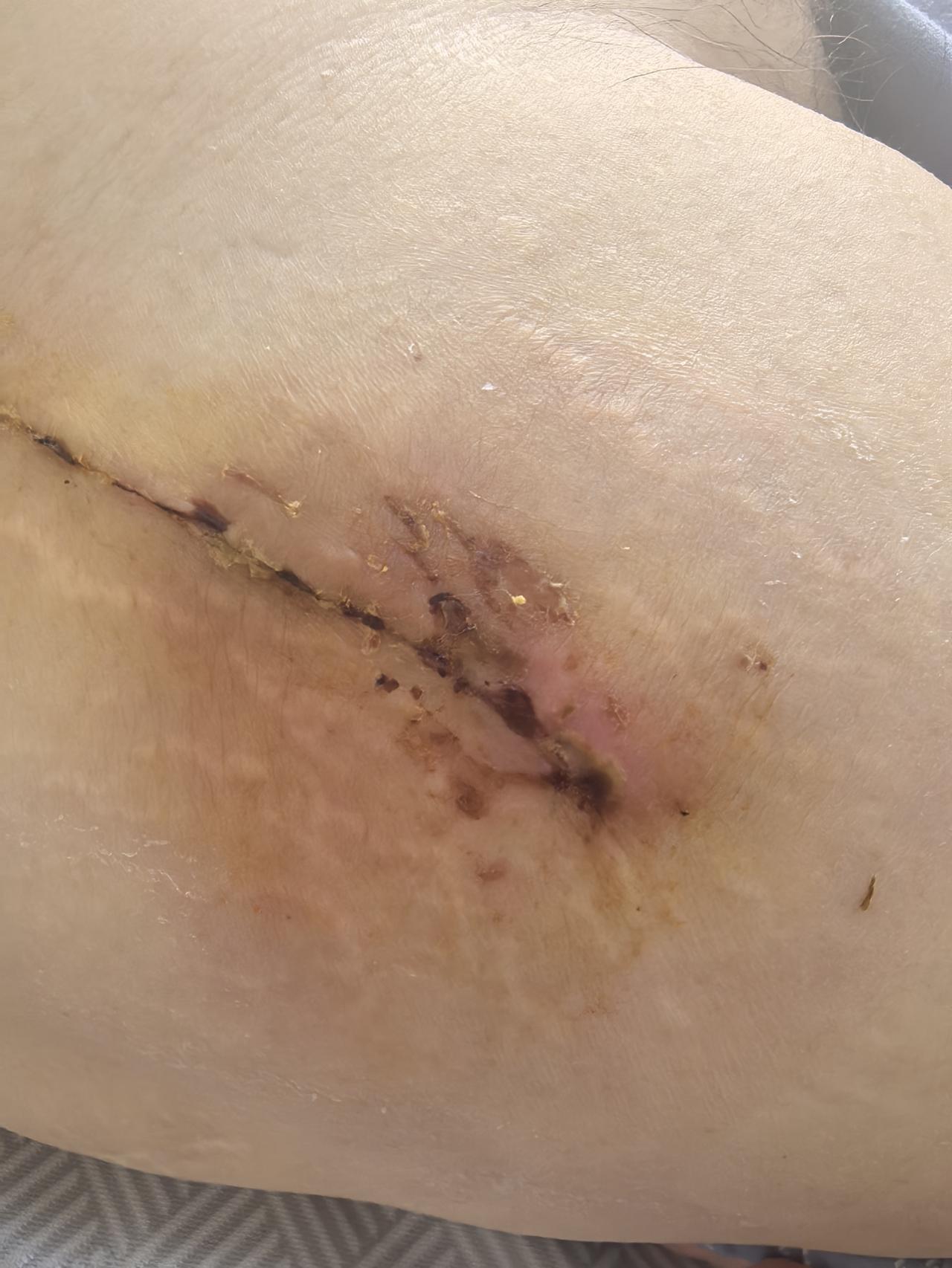 我爸从上海做髋关节翻修术回家第三天。一大早我去我爸家看望伤口有些发红。问了两个