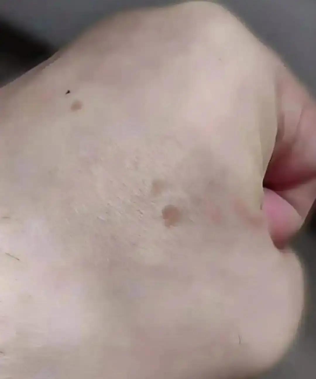 53岁突然满脸斑？别急，它可能晚来7年老年斑不是老年才长，48岁就开始埋伏