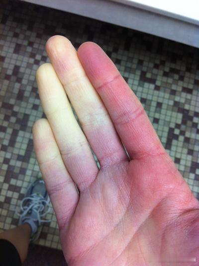 手腕疼痛盘点提起手腕疼痛，之前讲的比较多的是：01.腱鞘炎02