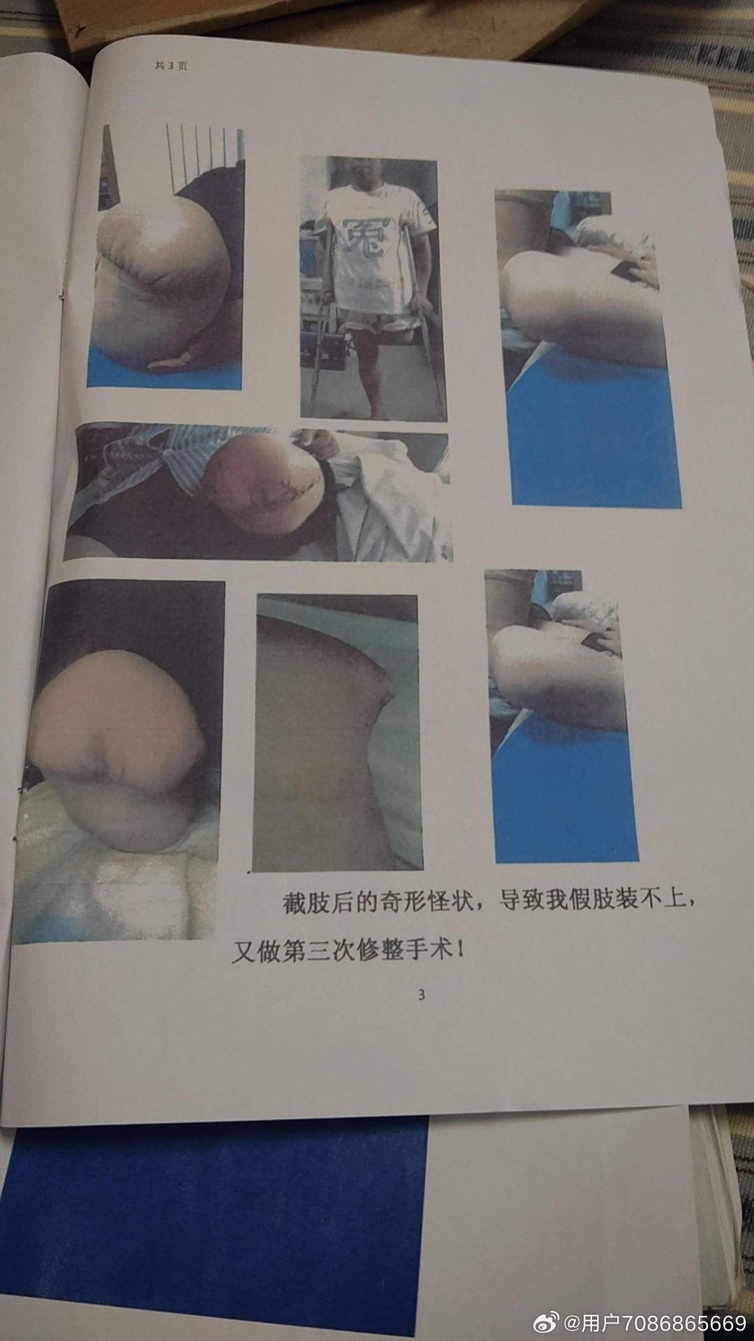 血泪控诉！（发布于2026年8月26日）河科大一附院（洛阳老三院）骨外科医生：林力：给我做腘窝脂肪瘤