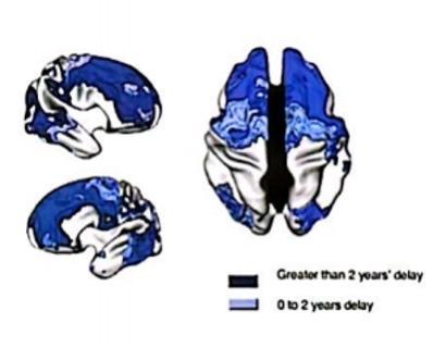 ADHD是一个大脑的疾病大脑结构异常  ·全脑灰质/白质/皮层下结构体积减少