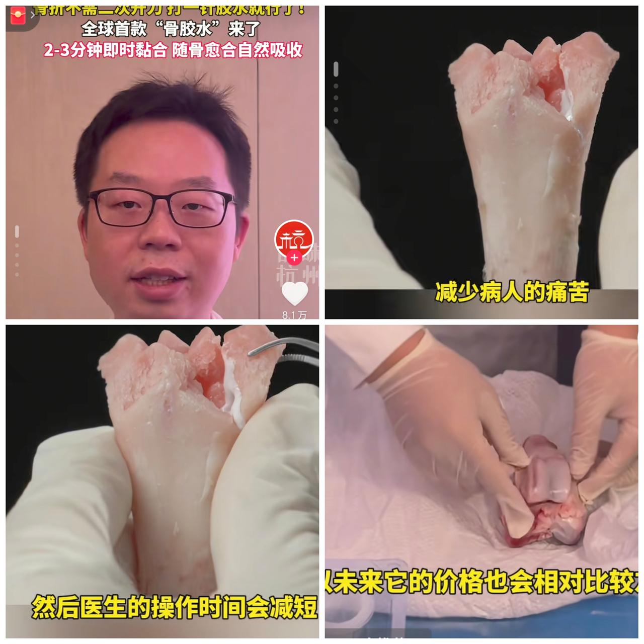 中国医疗又出王炸了！！！直接震撼全世界！浙江邵逸夫医院研发出的全球首款“骨