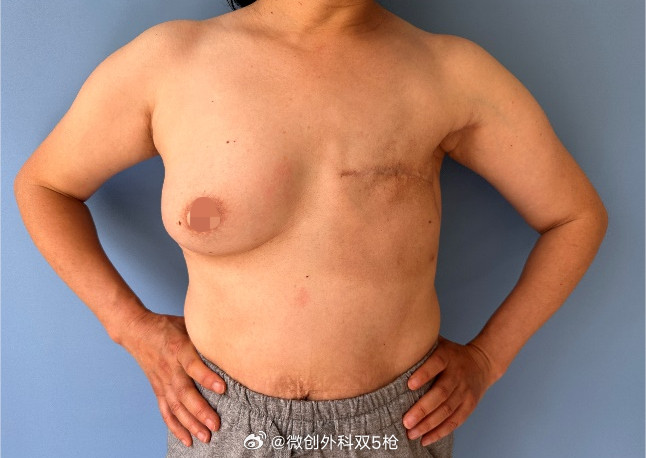 一万个普通女性里面，大约300‑450个人，一生中会得乳腺癌。也就是：大概每22‑33个女性里面，会