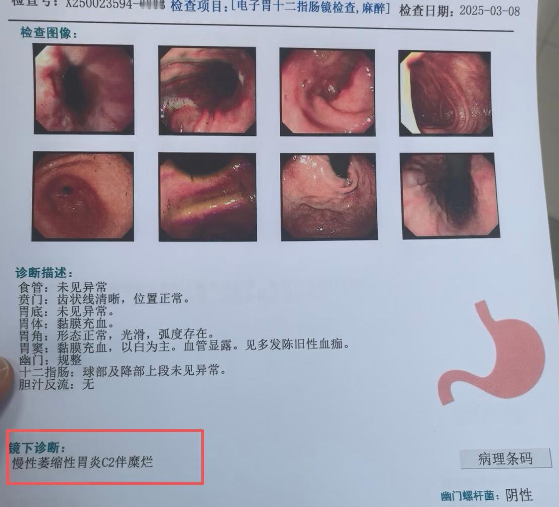 推开诊室的门，老陈握着最新的胃镜报告，眼圈微红。九个月前，他还记得自己第一次躺