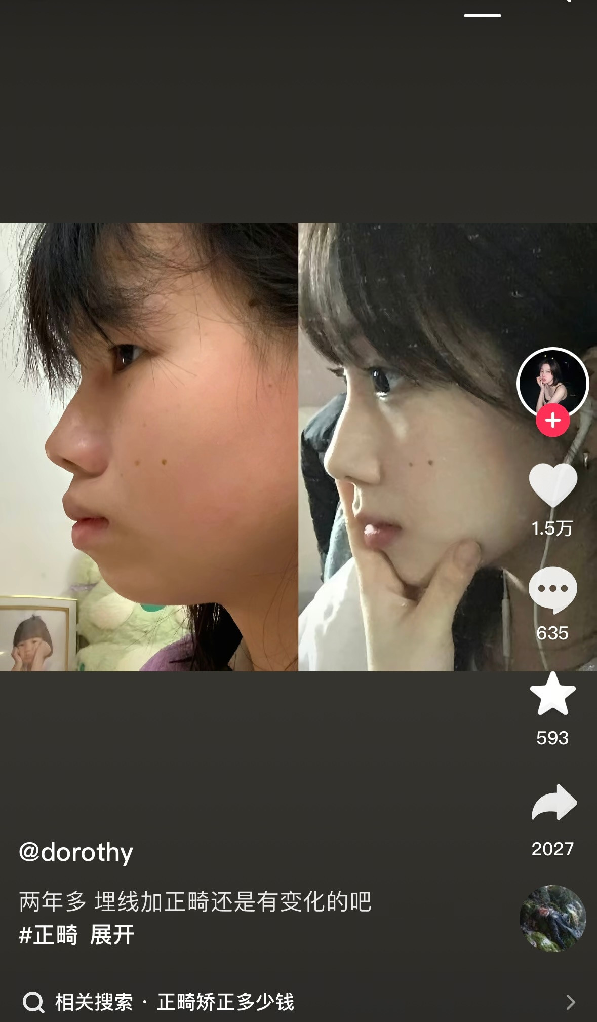 刷到简直震惊了正畸最上大分的一次….​​​