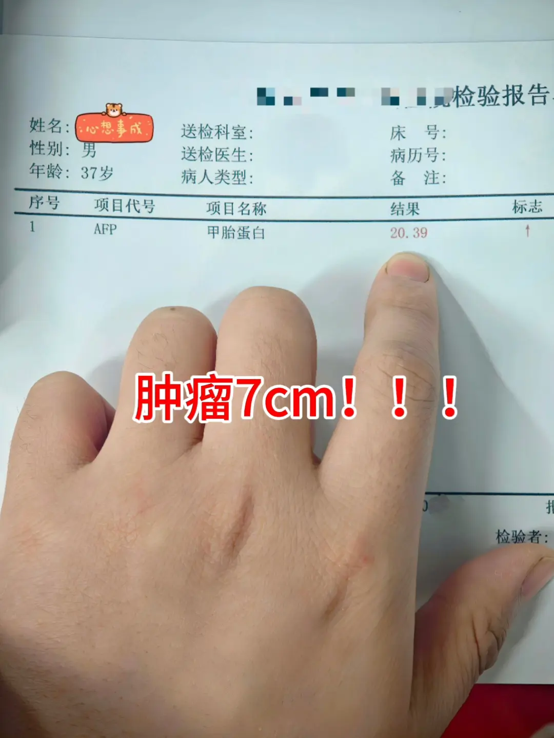 肝硬化患者可得注意了！这位患者甲胎蛋白仅 20，身体上啥症状都没有。做...