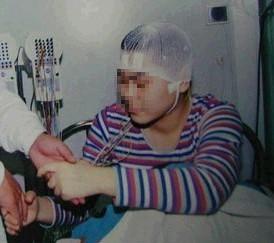 我们应该如何减少抗羊癫疯药物的副作用