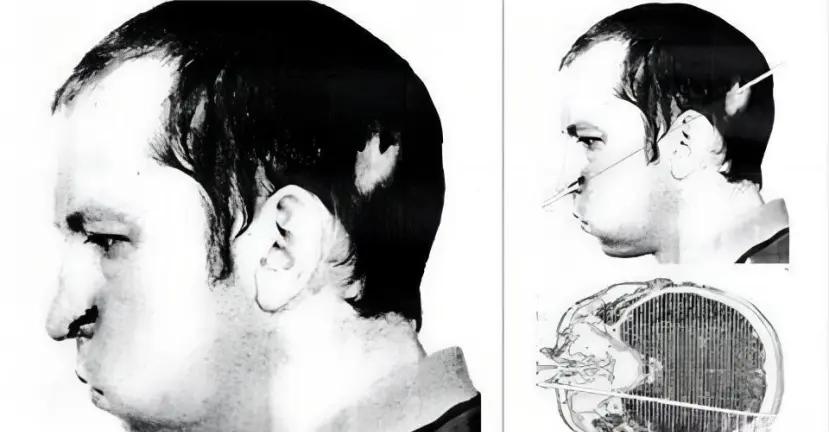 1978年，苏联一位物理学家，不小心被高辐射的粒子光速击穿脑袋，然而，奇迹发生了