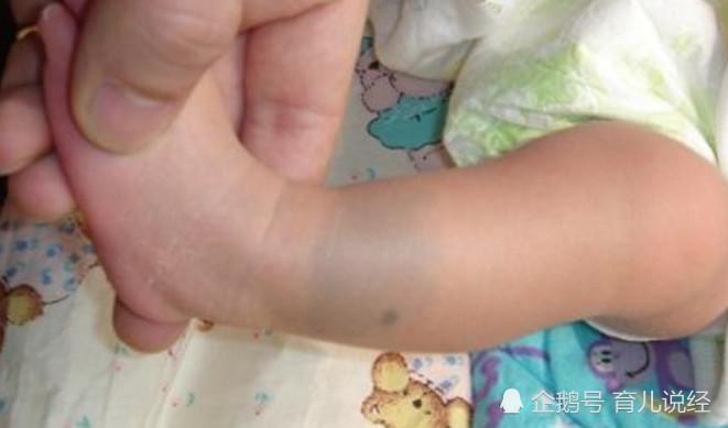 孩子身上长的这些胎记 你们知道这是什么原因长出来的吗