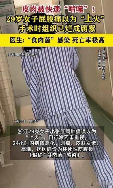 29岁的浙江女子小张突发肛周肿痛，误以为只是普通“上火”，自行涂抹药膏后完全没放