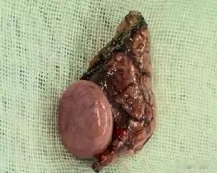 这是老婆肺部取出的增生物，虽然经过多轮检查属于良性，仍然放心不下。整个手术花了四