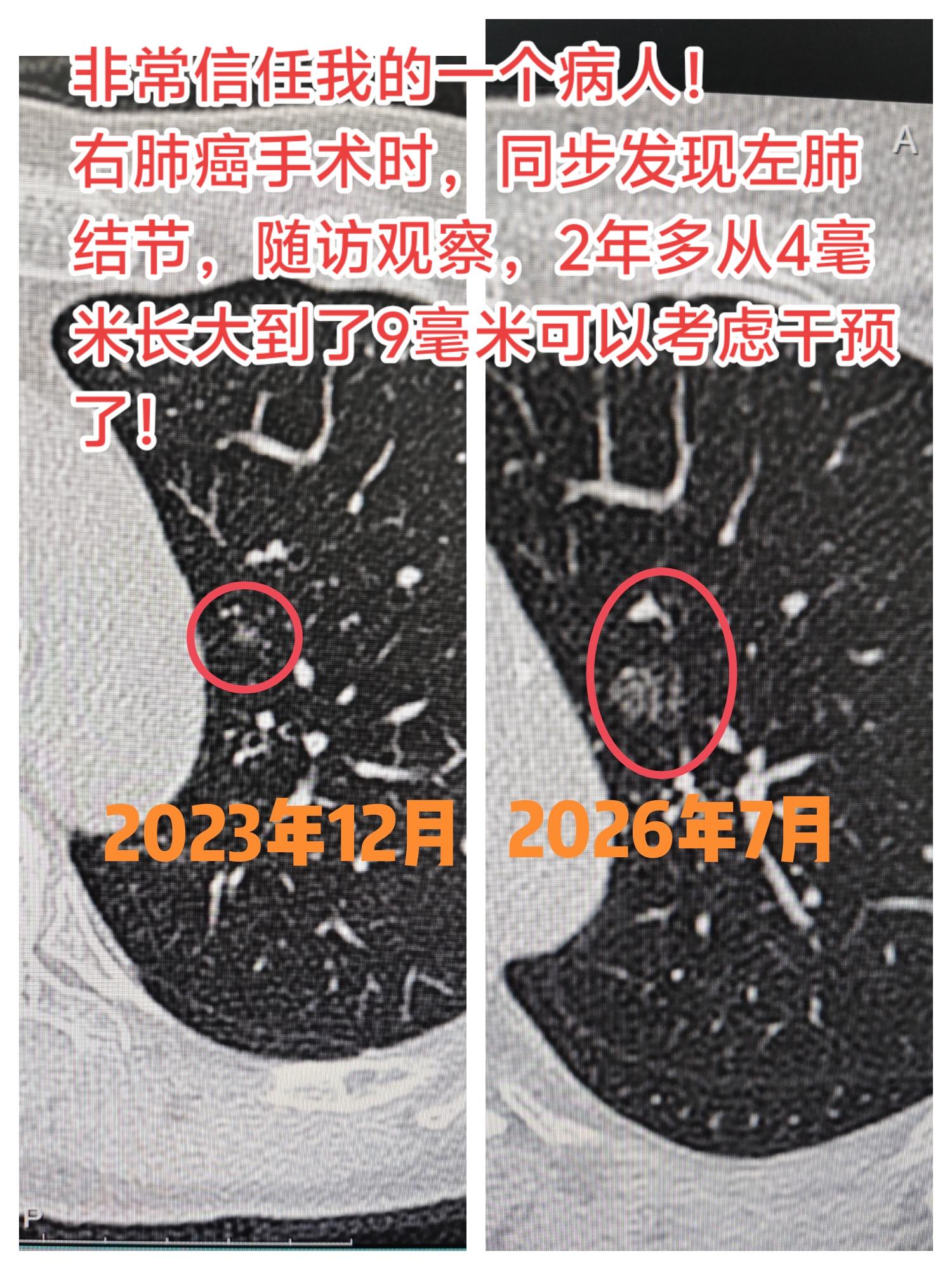 肺结节随访观察的重要性。很多人体检查出 ，要么过度恐慌立刻手术，要么完...