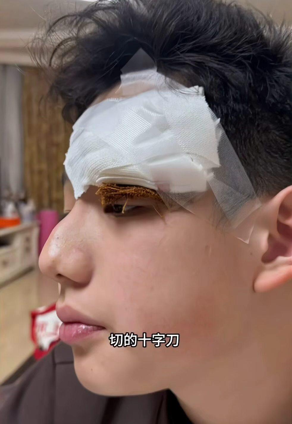 女明星为孩子挤痘，竟导致孩子脸部需缝四针近日，知名女演员关凌在社交平台发布视