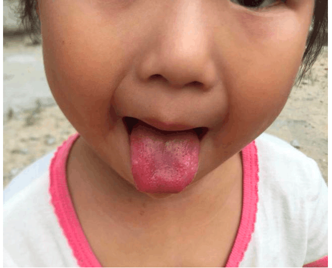 这不是孩子咳嗽发烧, 而是积食导致的