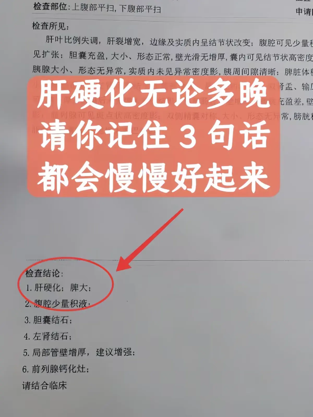 今天接诊的这位患者，刚确诊就已经是肝硬化晚期了，一肚子腹水！量大、腹胀...