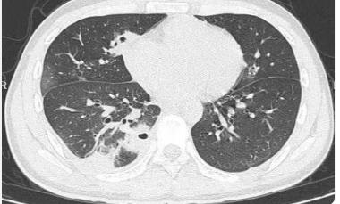 刷到20岁男生肺被查出10多个空洞的新闻，我直接惊掉下巴！本该是跑跳都带风的年纪