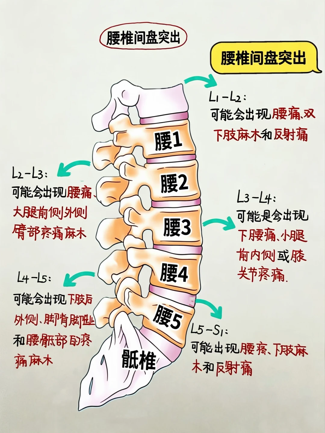 今日学习打卡——腰椎间盘突出