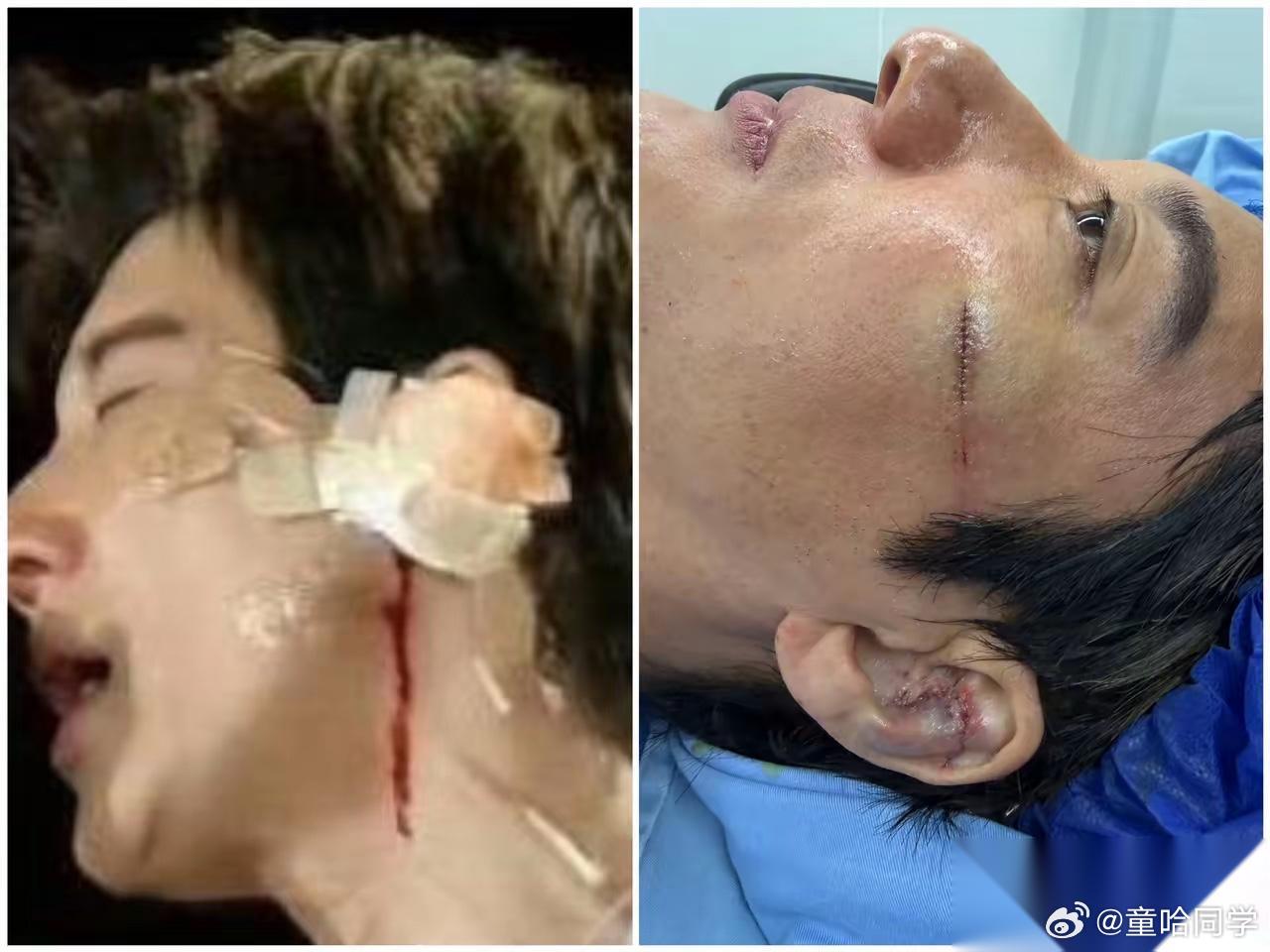王力宏演唱会受伤缝了39针会不会留疤我不知道但是我看出来了，他伤口缝合的这针