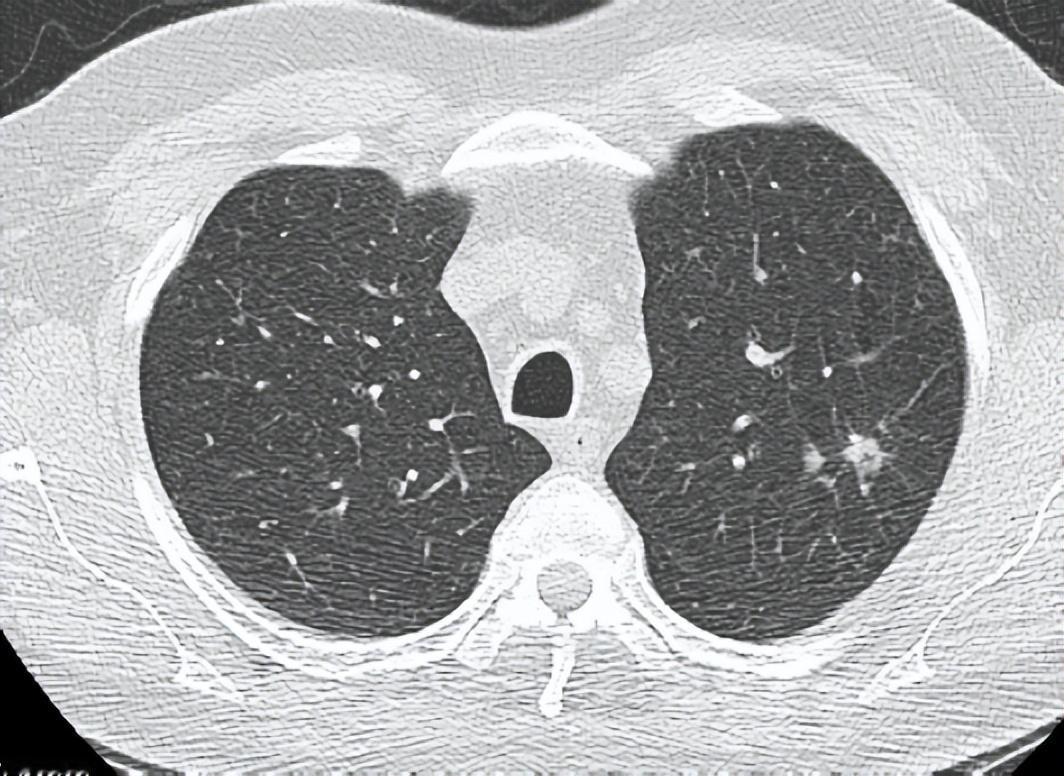 切结节为啥要“连坐”？医生揭秘肺部手术的“排雷”逻辑拿到肺部结节手术方案