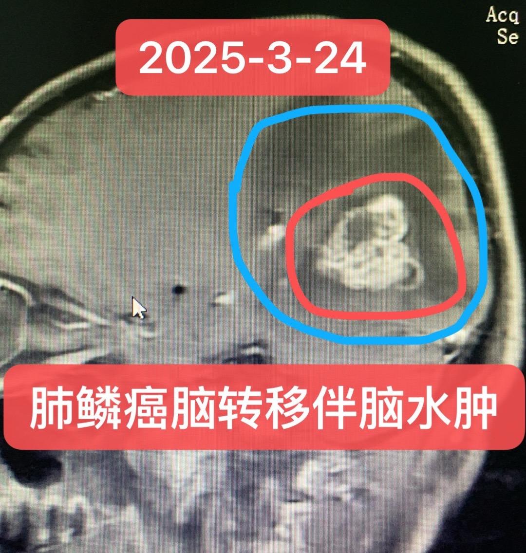 肺鳞癌脑转移的治疗。男，72岁，2025年3月，因头晕入院，CT及PE...