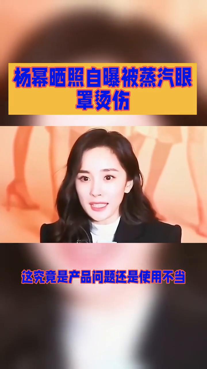 杨幂晒照自曝被蒸汽眼罩烫伤。杨幂晒照自曝被蒸汽眼罩烫伤，这究竟是产品问题还是使