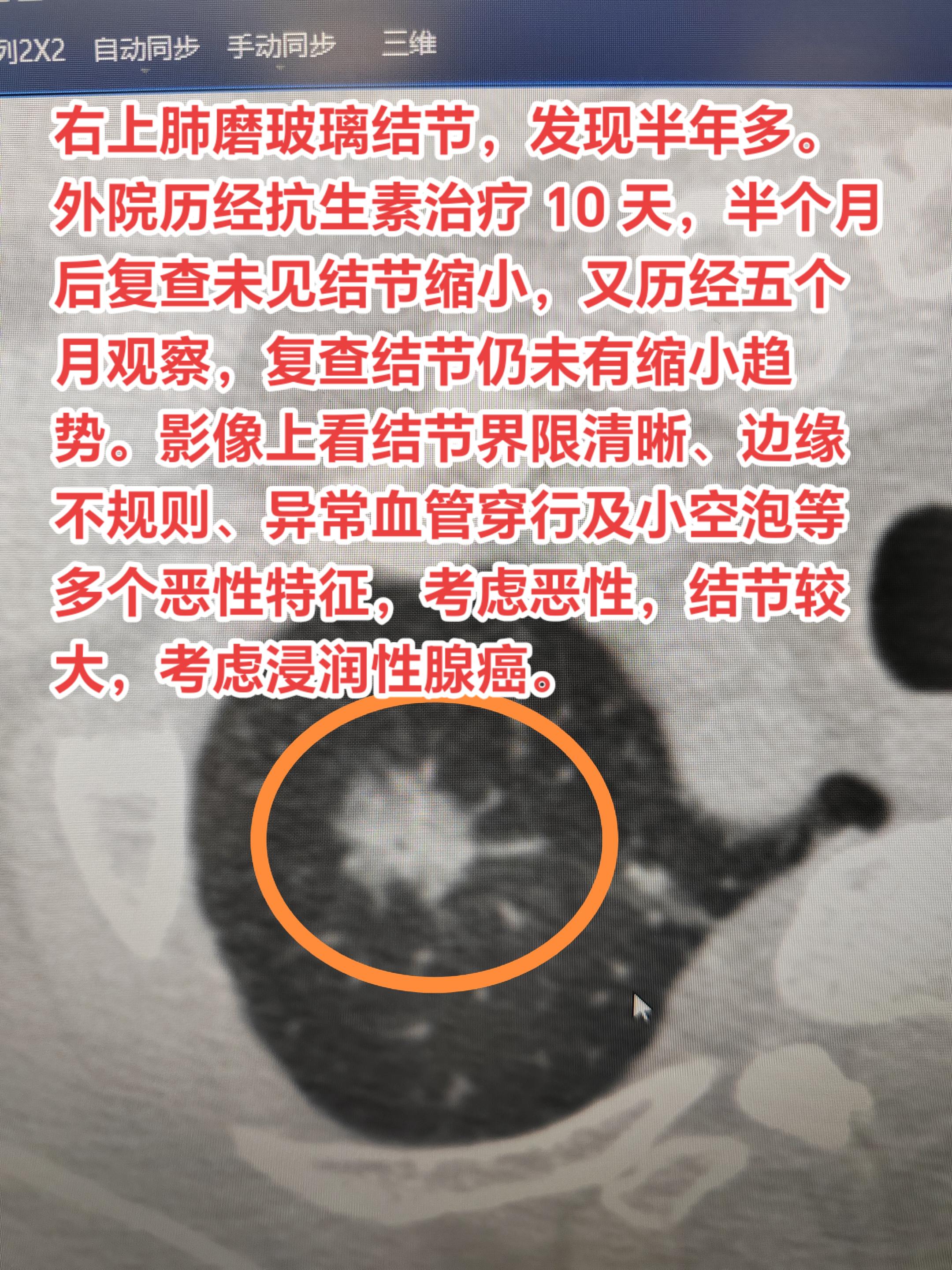 注意第一次发现磨玻璃结节并不着急手术！术中确诊了肺癌。那么这个混合型密...