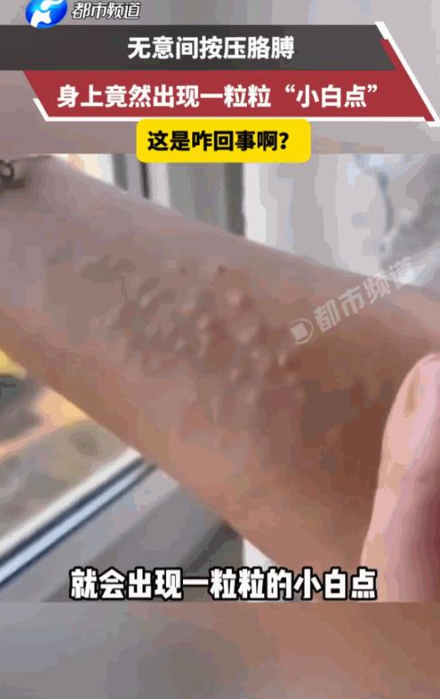 太吓人了！6月22日，河南，一位网友洗完澡后只是无意间按了一下自己的胳膊，谁承想