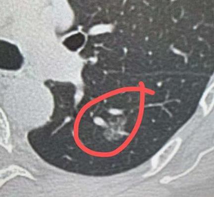 肺磨玻璃结节有血管穿过，癌细胞会全身扩散？平时在门诊，经常碰到很多朋友带着肺结节
